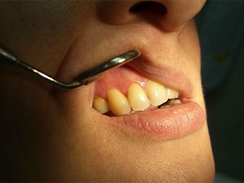 Флюс как лечить в домашних условиях после удаления зуба